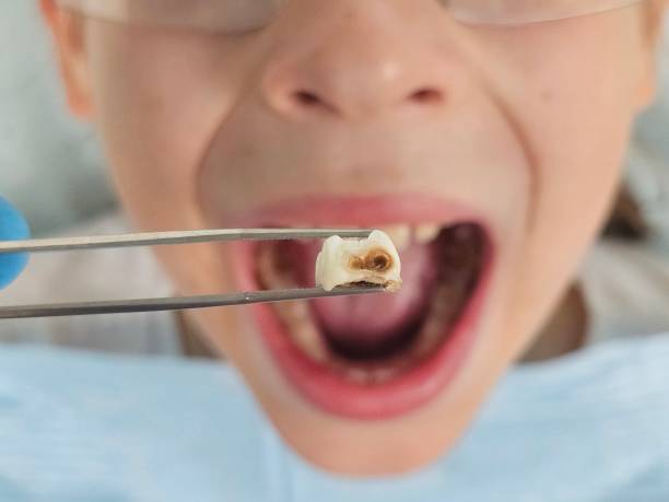 Best Emergency Broken Tooth Repair in Chickasaw, AL