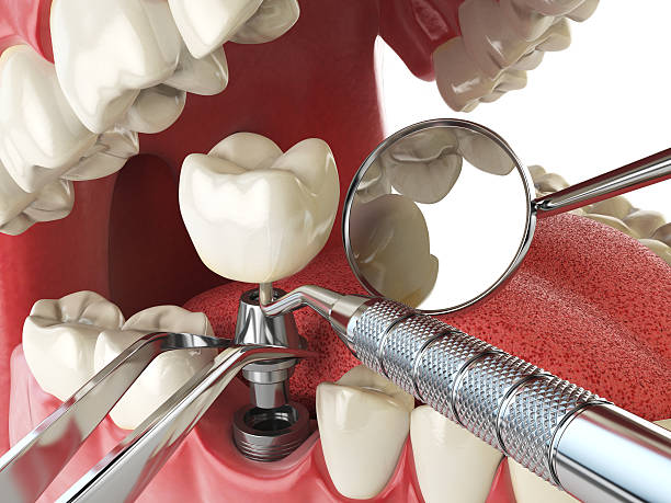 Best Emergency Tooth Extraction in Chickasaw, AL